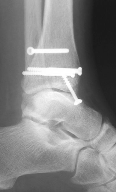 Ankle & Distal Tibia Fracture Fixation & Stabilization ...