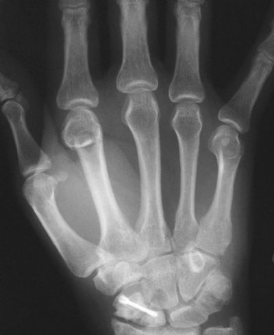 Wrist: Screws & Plates - orthopaediclist.com