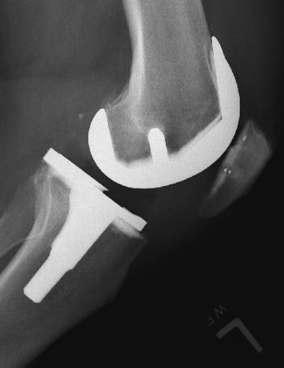 Эндопротез коленного сустава фото как выглядит