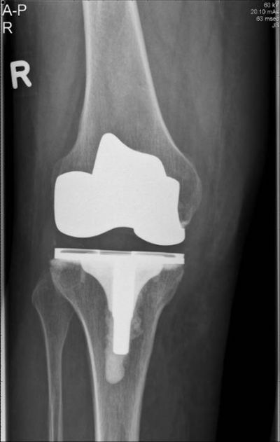 Implant Identification - orthopaediclist.com