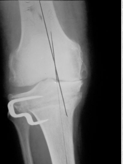 Tibia: Proximal - orthopaediclist.com