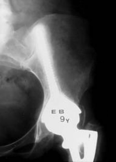 Hip Prostheses: Total, Primary - orthopaediclist.com