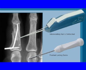 Small Bone Fixation System for the Hand (Prod 1659) - orthopaediclist.com