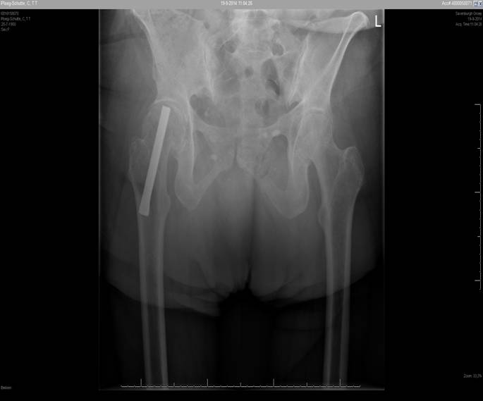 INTERNAL FIXATION WITH SMITH/PETERSEN NAIL AND EXTENSION BAR IN TREATMENT  OF INTERTROCHAN TERIC FRACTURES OF FEMUR