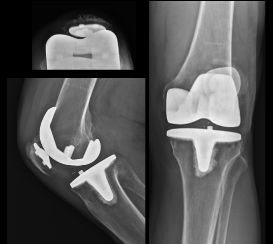 Endotec Buechel-Pappas Tricompartmental Total Knee Prosthesis (Implant 2304251)
