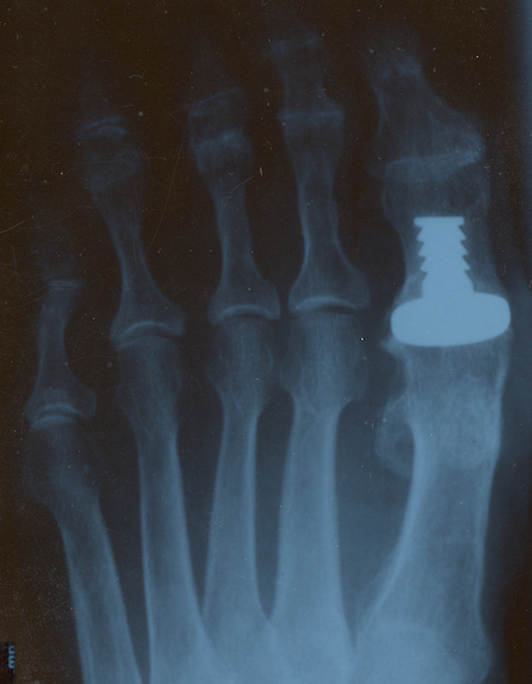 BioPro Metatarso-Phalangeal Joint Hemi Prosthesis (Implant 2011242)