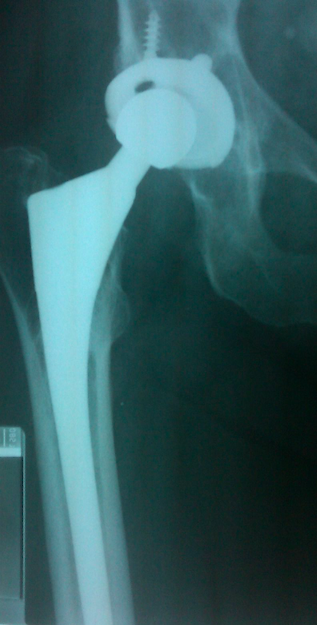 Biomet Mallory-Head Total Hip Prosthesis  (Implant 4246)