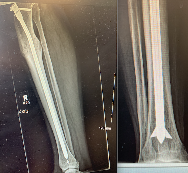 Brooker Interlocking Tibial Nail (Implant 191103)