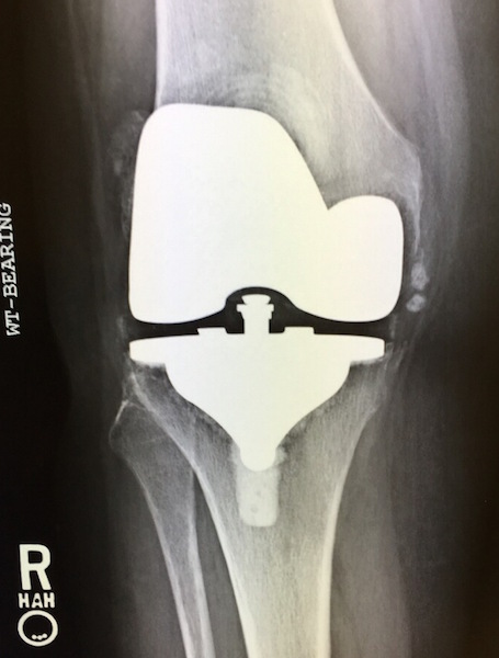 DePuy AMK Total Knee Prosthesis (Implant 160608AP)
