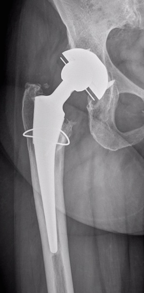 Hip Prostheses: Total, Primary - orthopaediclist.com
