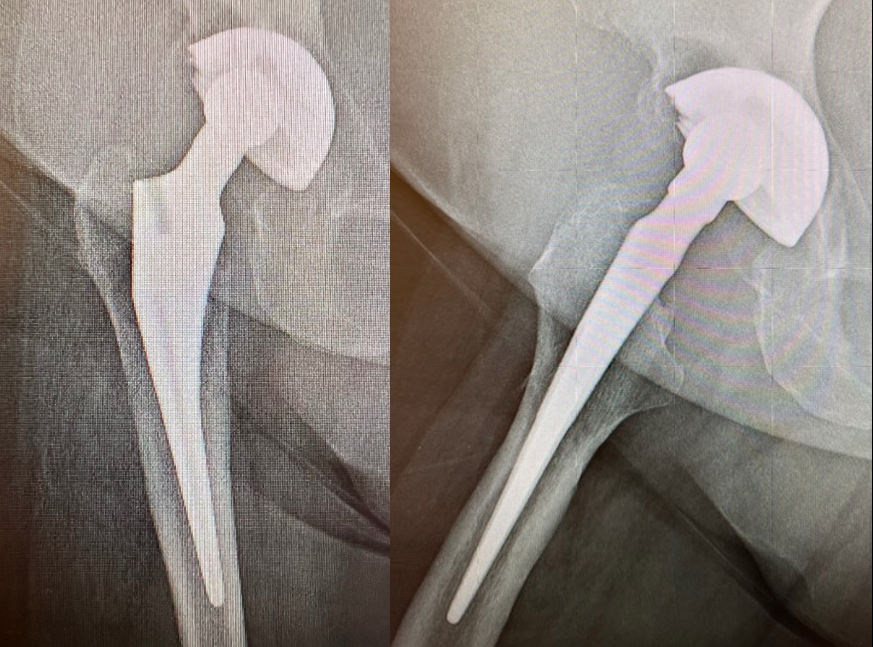 Hip Prosthesis, Total:  Unidentified (Implant 230510)