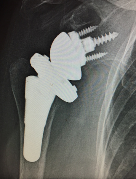 Biomet Reverse Total Shoulder Prosthesis with Micro Stem, AP View (Implant 1712091)