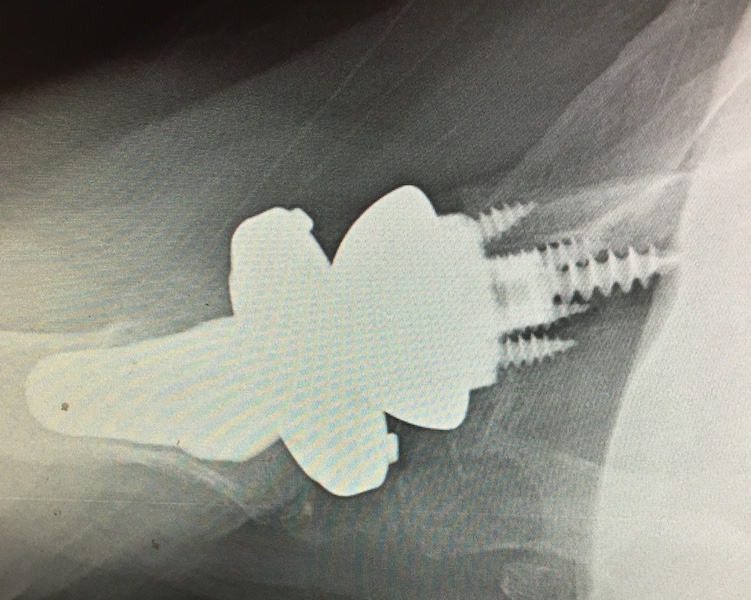 Biomet Reverse Total Shoulder Prosthesis with Micro Stem, Axillary View (Implant 1712092)