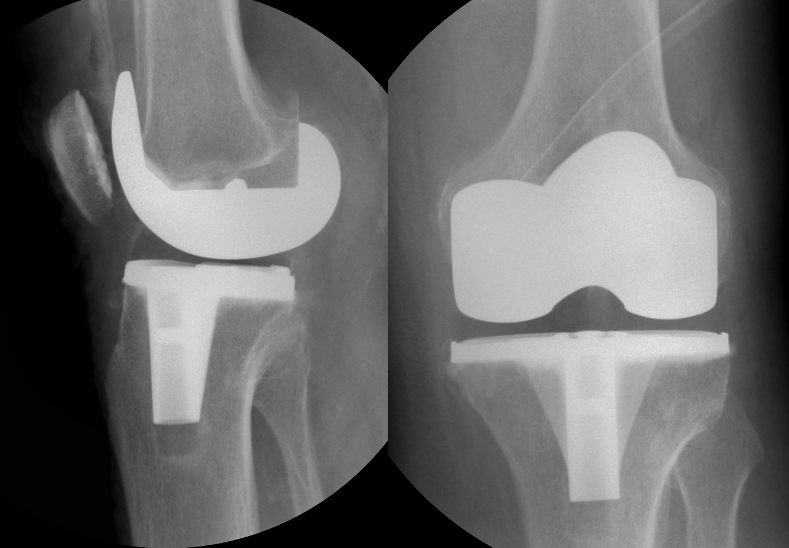 Zimmer Biomet NexGen PS Total Knee Prosthesis (Implant 20210301)