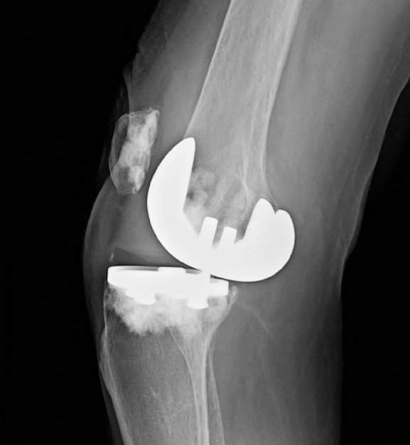 Zimmer NexGen Total Knee Prosthesis with MIS Pegged Tibial Component  (Implant 4248)