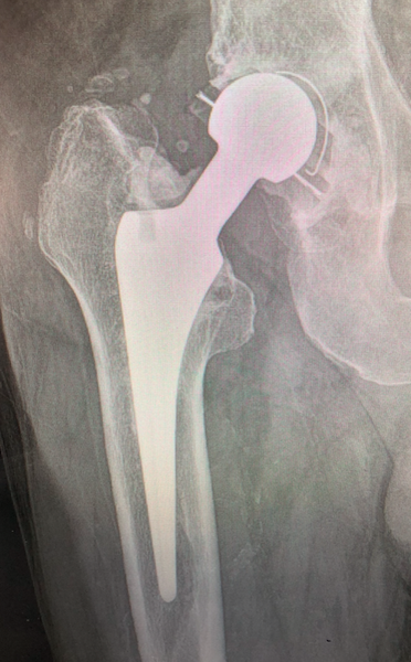 Hip Prosthesis, Total, Unidentified (Implant 220421)