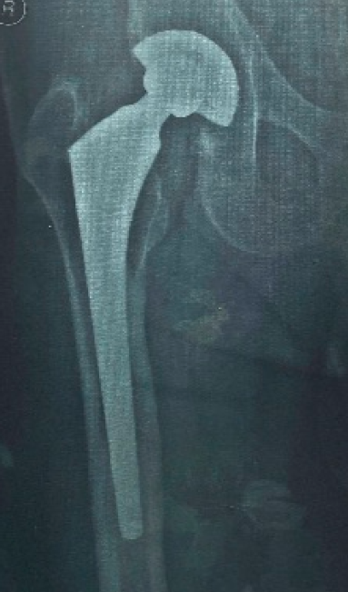 Unidentified Total Hip Prosthesis (Implant 230515)