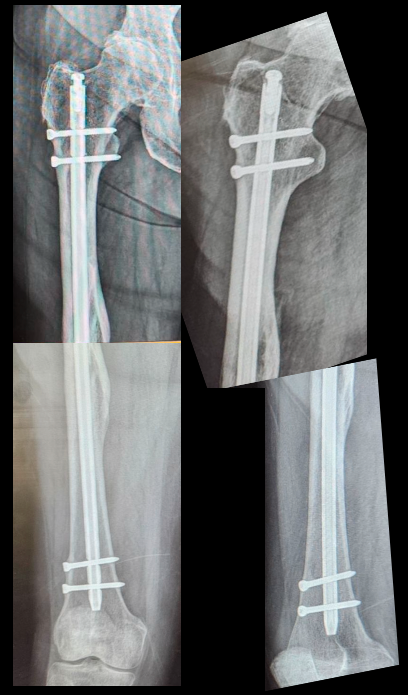 Femoral Nail, Unidentified (Implant 241205)