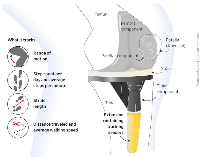 Persona IQ Total Knee Prosthesis (Prod 2304241)