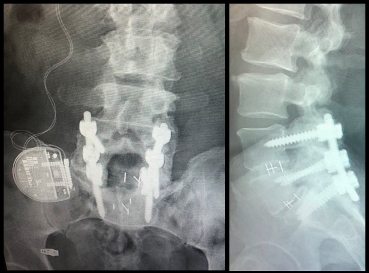 Medtronic CD Horizon Pedicle Screws and Crescent PEEK Cages (Implant 240131)