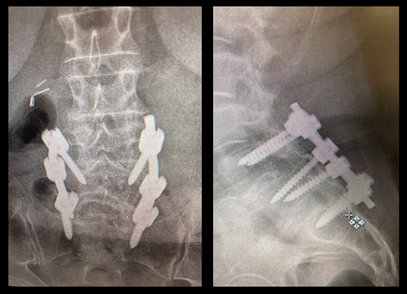 Spine Implants, Unidentified (Implant 240317)