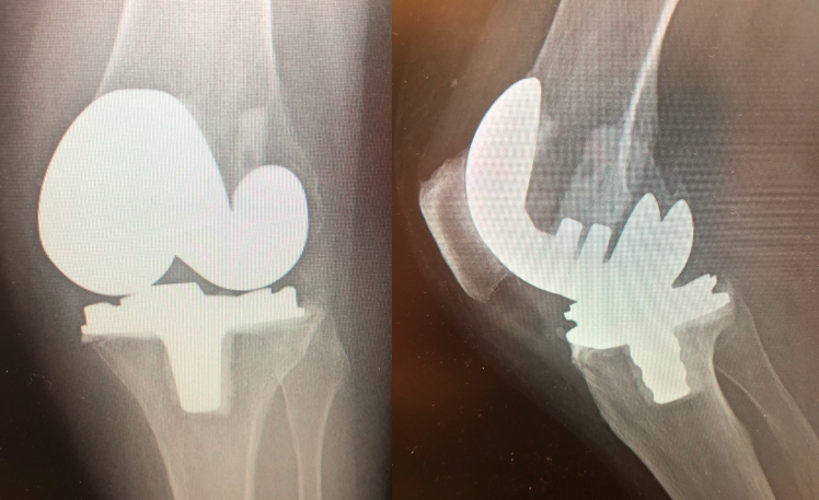 Zimmer Multi-Radius Total Knee System (Implant 210212)